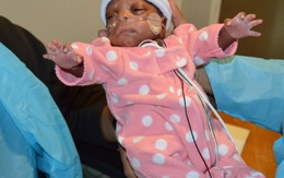Sức sống kỳ diệu của bé gái sinh non chỉ 14 tuần, nặng 2,8 lạng