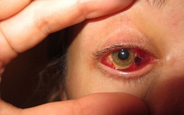 Cảnh báo biến chứng của tật khúc xạ có thể gây nguy hiểm cho mắt