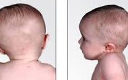 Bé 3 tuổi thoái hóa đốt sống cổ vì sự dễ dãi của bố mẹ