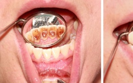 Không tốn tiền đi nha sĩ, hãy thử 3 cách lấy cao răng tại nhà