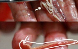 5 món ăn chứa nhiều ký sinh trùng đáng sợ nhất