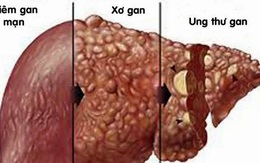 Viêm gan C: Nguy hiểm vì phát bệnh âm thầm