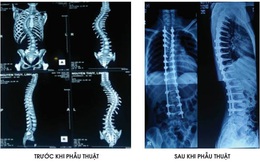 Bệnh viện Bạch Mai áp dụng công nghệ chẩn đoán, điều trị cột sống hiện đại nhất thế giới