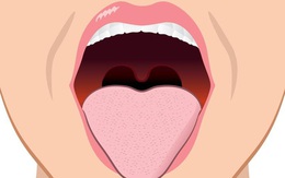 Hạch cuống họng - thủ phạm gây nhiều rắc rối sức khỏe nhưng lại bị nhiều người bỏ qua