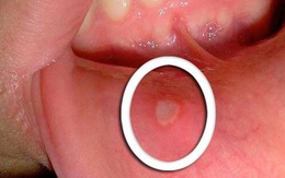 Đừng coi thường những vết loét trong miệng, đó có thể là dấu hiệu của 1 căn bệnh ung thư!