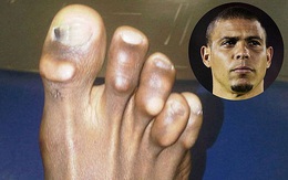 Vì vinh quang, những Ronaldo, Villa... đã trả giá bằng đôi chân biến dạng "dị" như thế này đây