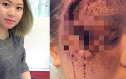 'Lộ' sự thật hình ảnh vợ bị chồng tẩm xăng đốt biến dạng khuôn mặt