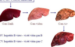 GS Nguyễn Chấn Hùng: Điểm mặt những bệnh ung thư đến từ virus, từ miệng