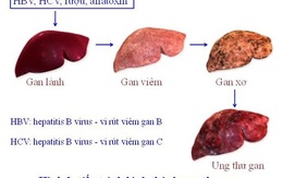 GS Nguyễn Chấn Hùng: Điểm mặt những bệnh ung thư đến từ virus, từ miệng