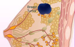 Có hay không chẩn đoán giả trong sàng lọc ung thư vú?
