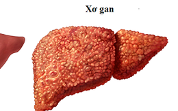 Biến gan thành "xỉ than" vì sát thủ 2.000 đồng mỗi ngày