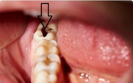 Tìm thấy 1 thực phẩm ngừa sâu và làm trắng răng an toàn, hiệu quả hơn cả kem thông thường