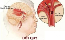 Những biện pháp hỗ trợ giúp bệnh nhân đột quỵ mau hồi phục