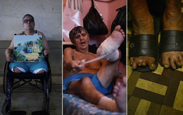 Ám ảnh cuộc sống bên trong trại trập trung bệnh nhân phong ở Brazil