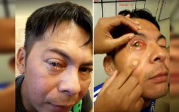 Người đàn ông bị ký sinh trùng ăn mòn giác mạc, mù tạm thời vì đeo kính áp tròng