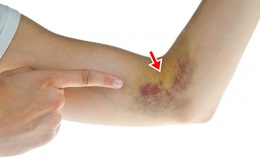 Bầm tím trên da: Chớ coi thường vì đây có thể là dấu hiệu các bệnh rất nguy hiểm