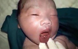 Hi hữu ở Hà Tĩnh: Sau ca mổ đẻ, bác sĩ bất ngờ vì bé trai sơ sinh mọc răng cửa