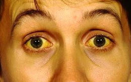 Mắt có một trong các dấu hiệu này, hãy cảnh giác nguy cơ mắc 9 loại bệnh nguy hiểm