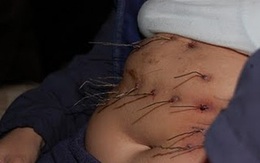 Dị nhân: Cô gái bị dây thép mọc khắp người, xuyên qua da dài 10-20 cm
