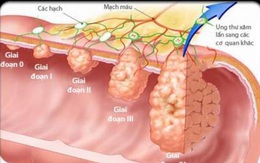 Chuyên gia Malaysia: 3 cách phát hiện sớm, loại bỏ ung thư đại trực tràng từ "trứng nước"