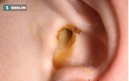 Viêm tai giữa biến chứng của viêm mũi: Điều trị thế nào?