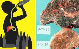 Bác sĩ BV Bạch Mai "chỉ mặt" kẻ tàn sát sức khỏe ghê gớm  nhất