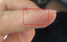 Dấu hiệu trên ngón tay chứng tỏ lục phủ ngũ tạng tích độc tố: Nên biết để thải độc ngay