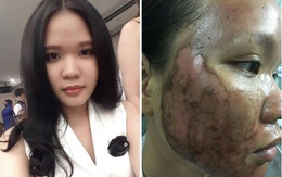 Ký ức kinh hoàng sau lần làm đẹp dại dột đến bỏng rộp cả mặt của cô gái trẻ