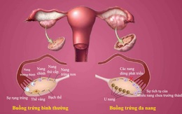 Căn bệnh dẫn đến tiểu đường, bệnh tim: Tránh xa 8 loại thực phẩm nếu bạn không muốn mắc