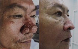 Bác sĩ công bố loạt ảnh hiếm về đàn ông Việt mắc bệnh mũi sư tử