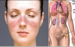 Lupus ban đỏ nguy hiểm như thế nào?