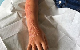 Bé gái bị bỏng và sẹo ở cánh tay suốt đời: Lời cảnh báo cho các bậc cha mẹ "chiều con"