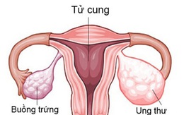 6 dấu hiệu cảnh báo bệnh ung thư buồng trứng, chị em cần lưu ý