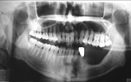 Cảnh báo: Bị đau răng chần chừ không đi khám, đến khi không chịu được thì đã hoại tử hàm