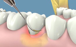 Bạn bị đau răng: Hãy nhớ những gia vị "giảm đau siêu tốc" an toàn, có sẵn trong bếp