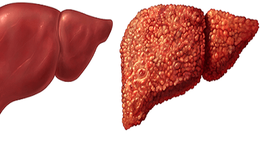 Đông y có 4 dấu hiệu cảnh báo sớm nhất bệnh xơ gan: Hãy tự nhận biết để khám chữa kịp thời