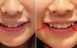 Đập xương hàm thành 3 ở Hàn Quốc và những chuẩn mực làm đẹp khác người của các nước