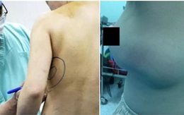 Sau 10 năm thẩm mỹ, người phụ nữ cay đắng gỡ miếng độn ngực đang dần trôi về sau lưng