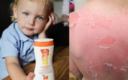 Dùng kem chống nắng SPF 50 đi dã ngoại, bé trai 3 tuổi bị cháy nắng và phồng rộp nghiêm trọng