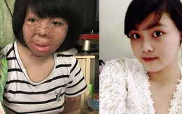 Cô gái bị chồng tẩm xăng đốt và hành trình trở về từ cõi chết