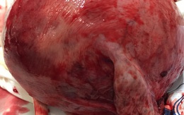 Hà Tĩnh: Phẫu thuật lấy thai cho sản phụ có khối u xơ tử cung nặng 2,8kg