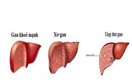 Bệnh gan tại Việt Nam - thực trạng đáng báo động