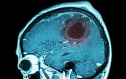 7 dấu hiệu cảnh báo khối u não bạn nên biết