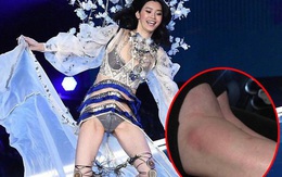 Lộ ảnh cổ chân sưng to, tấy đỏ của Ming Xi sau cú ngã "trời giáng" tại Victoria's Secret Fashion Show