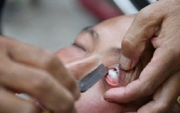 Làm sạch tròng mắt bằng… dao cạo