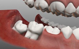 Chuyên gia giải đáp: Vì sao răng khôn thi thoảng trồi lên như 1 vị thần?