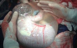 Khoảnh khắc bé sinh đôi ra khỏi bụng mẹ vẫn còn nguyên trong bọc ối