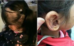 Bé gái 6 tuổi bị mẹ đẻ ngược đãi dã man khiến mặt đầy vết thương, tóc rụng thành mảng lớn