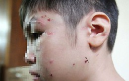 Đề nghị khởi tố vụ bé trai 10 tuổi bị mẹ kế bạo hành ở Hà Nội