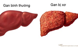 Dù gan còn khỏe vẫn phải tránh xa 5 nguyên nhân này kẻo xơ gan "gõ cửa"